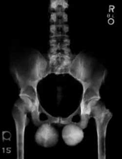 An xray of Elon Musk's Gonads ( Balls of Steel)